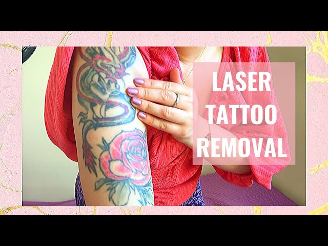 😩LASER TATTOO REMOVAL UPDATE - 2ND SESSION