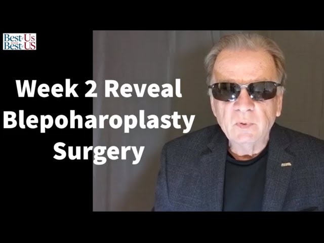 I Had Upper Lid Blepharoplasty Surgery Two Weeks Ago. Eyelid Surgery Week 2 Reveal