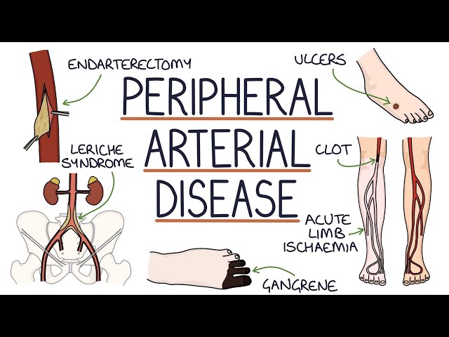 Understanding Peripheral Arterial Disease