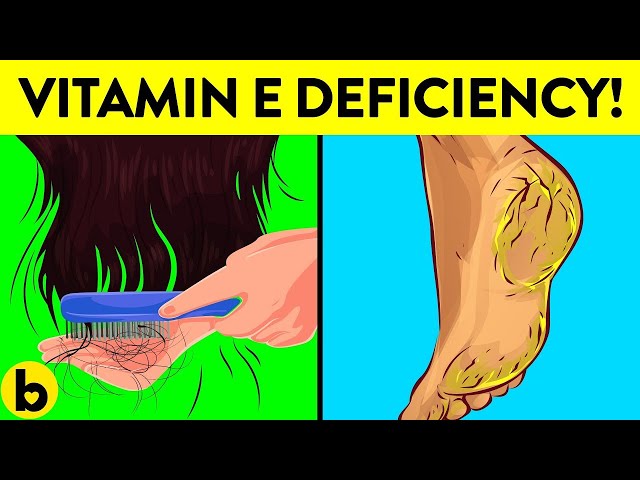 Signs Your Body Is Lacking Vitamin E & Its Benefits
