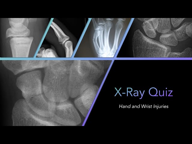 X-ray Quiz: Hand and Wrist Injuries