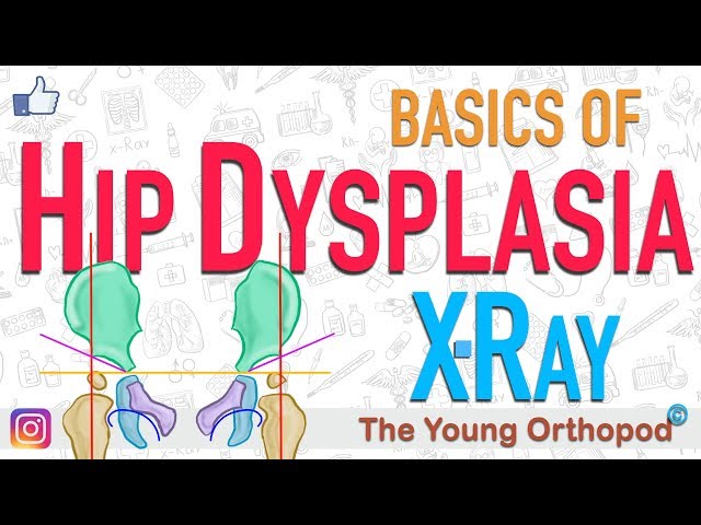 Developmental Dysplasia of Hip, DDH X Ray features, NEET PG, USMLE, Dysplastic hip, CDH