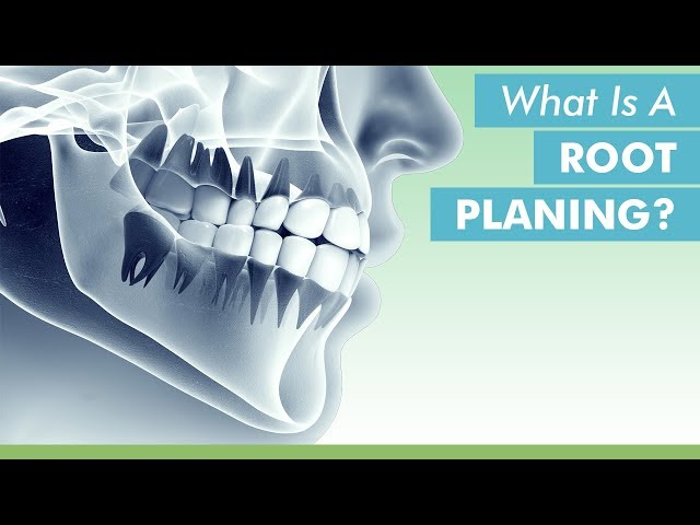 What Is A Root Planing?