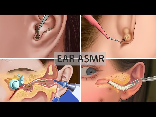 ASMR|ear pimple blackhead care|sebaceous cyst removal|Water Device Removes Earwax| Ear cleaning