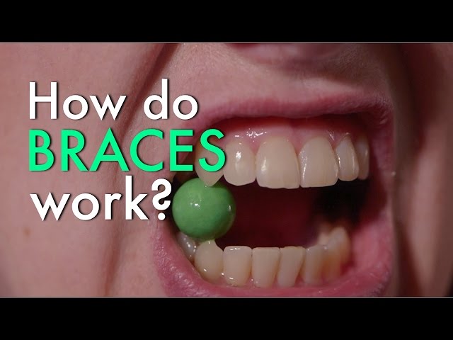 How Do Braces Work?