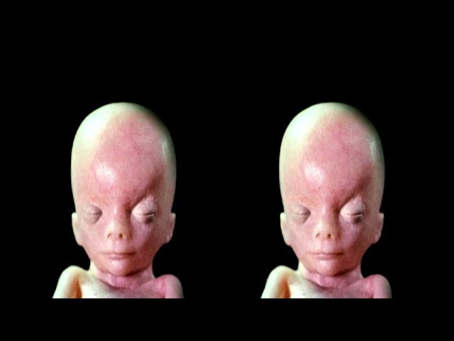 In the Womb - Identical Twins