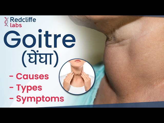 (घेंघा)✳️ Goitre Disease Symptoms and Treatment in Hindi | ✳️ Goitre Causes, Types And Symptoms