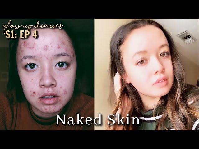 Acne to clear skin journey | Glow up Diaries Episode 4
