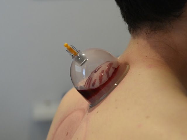 What is Cupping?