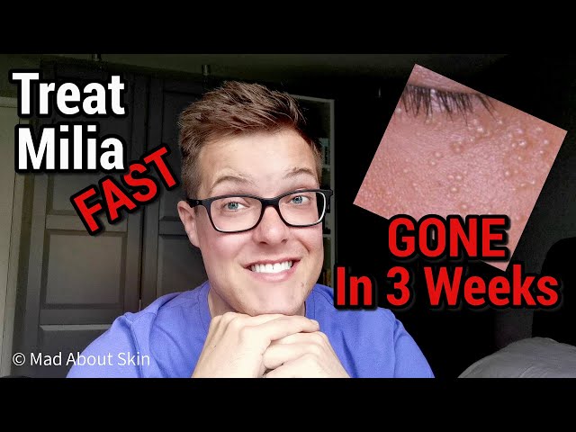 How To Get Rid Of Milia (FAST) - White Spots Under The Eyes