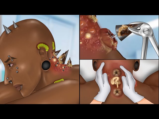 ASMR Popping pustules on nape piercing implant animation | Body modification