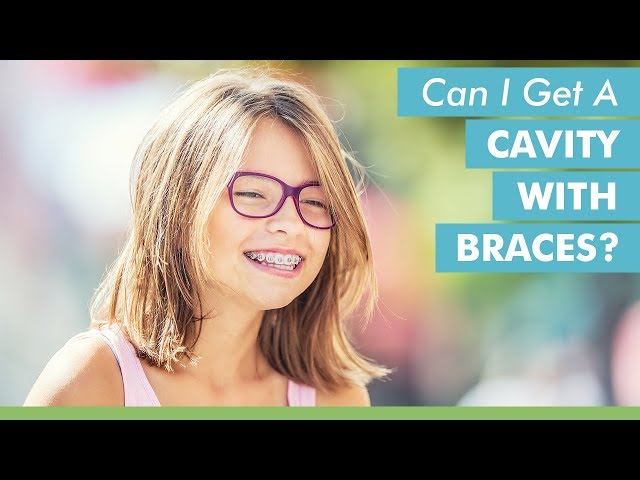 Can I Get A Cavity With Braces?