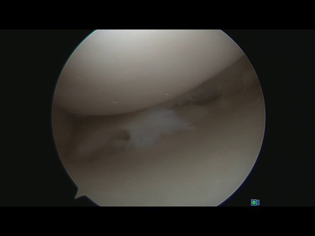 Knee arthroscopy - meniscus repair