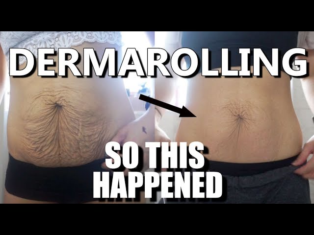 I Tried DERMAROLLING my Saggy Skin  & This Happened! (Astonishing Results)