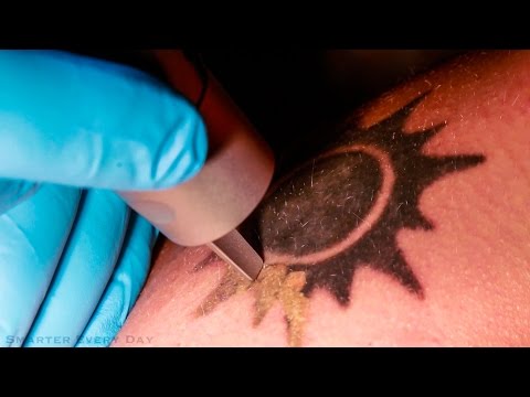 How Laser Tattoo Removal Works - Smarter Every Day 123