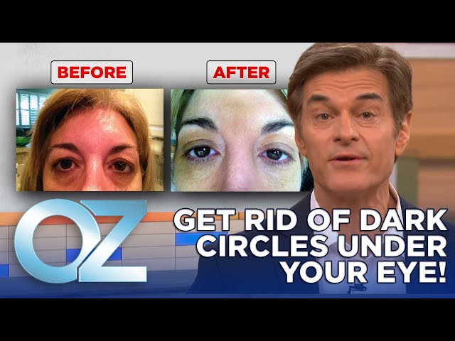 How to Get Rid of Dark Circles Under Your Eyes | Oz Beauty & Skincare