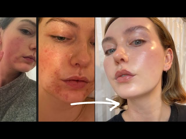 From rosacea + acne to glass skin — this skincare works