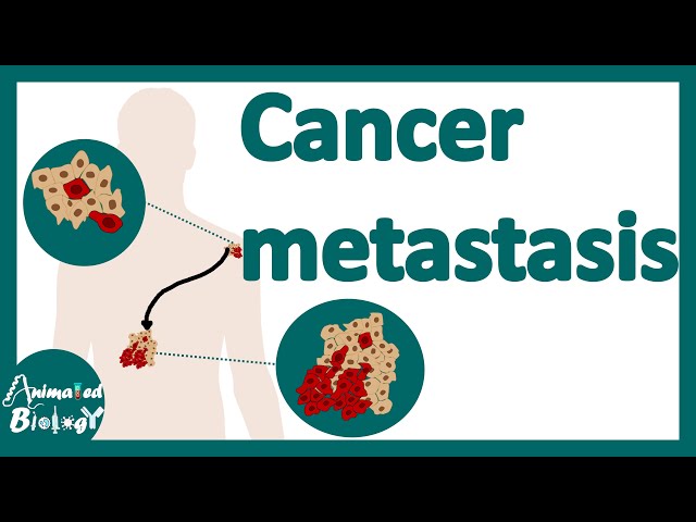Cancer Metastasis | cancer metastasis mechanism | Metastasis | How do cancers spread in the body?