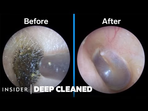 How Earwax Is Professionally Deep Cleaned | Deep Cleaned
