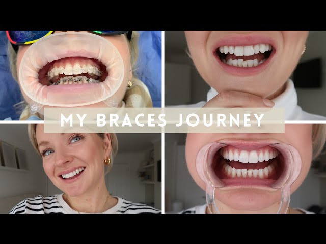 MY ADULT BRACES JOURNEY, TEETH TRANSFORMATION, WEARING FIXED CERAMIC BRACES, WITH BEFORE AND AFTERS