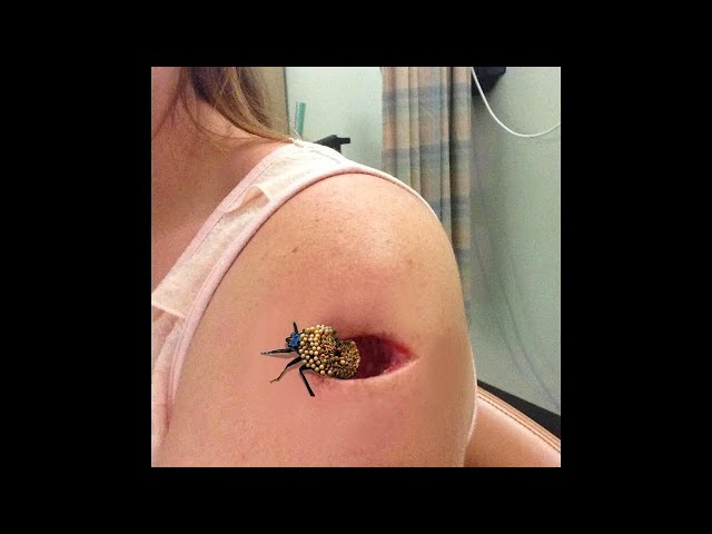 this BUG was in my arm...