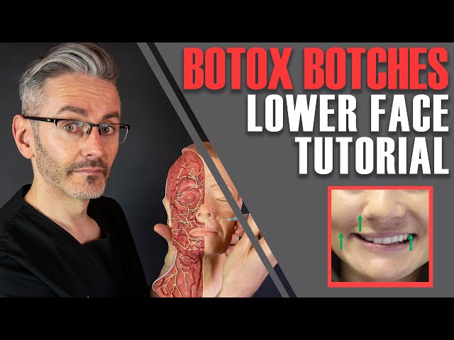 ADVANCED BOTOX ANATOMY: How to avoid nasty lower-face side effects [Aesthetics Mastery Show]