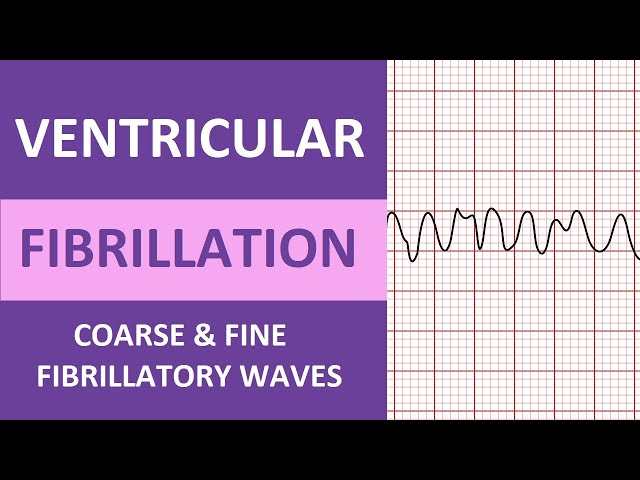 Ventricular Fibrillation (V-Fib) ECG Interpretation Nursing Heart Rhythms  NCLEX ACLS