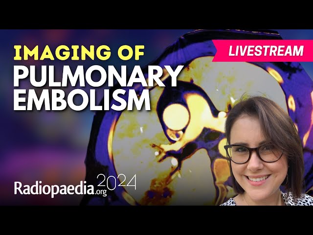 Imaging of Pulmonary Embolism with Sally Ayesa