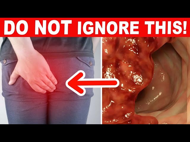 10 Early Warning Signs Of Colon Cancer You Should Never Ignore