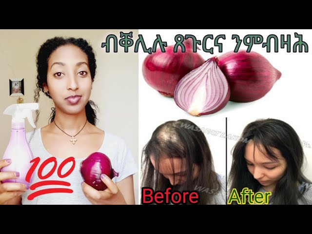 ንዝሰሓወን፡ ንምብራሕ ዝጀመረን ጸጉሪ ፍቱን መፍትሒ!!! Best remedy for hair-loss treatment!!!