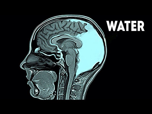 This Woman Drank 21 Liters of Water in 24 Hours. This is What Happened to Her Brain...