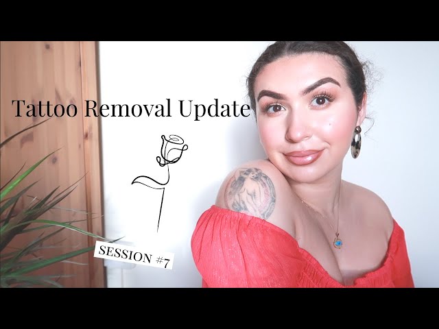 Quick Tattoo Removal Update - 7th Session😬