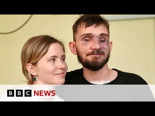 How Ukraine's war wounded repair their lives - BBC News