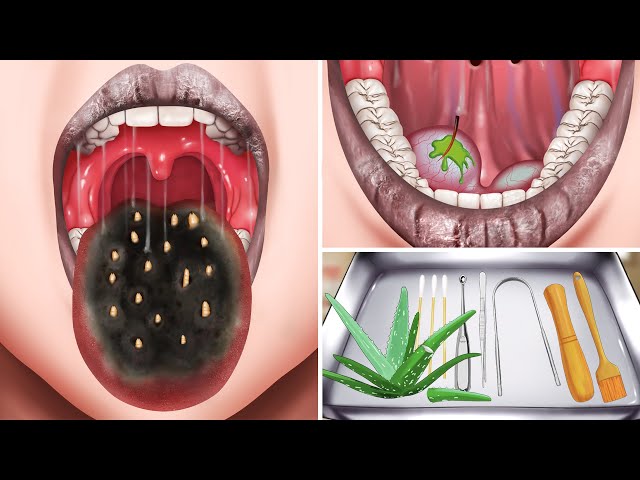 ASMR Treatment tongue infested with maggots animation