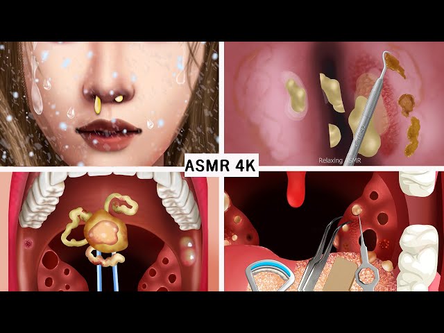 ASMR 치료 콧물, 편도선 | Treatment and cleaning nose, Tonsil stones, white tongue | Treatment Animation
