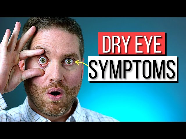 DRY EYES - The Surprising SYMPTOMS And Causes Of Dry Eye Syndrome