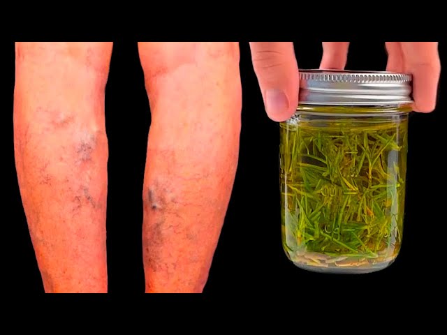 Unbelievable! Varicose veins disappear with rosemary Treasure that everyone should have in their