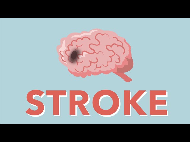 Can you recognize a stroke?