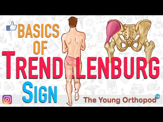 Trendelenburg's Sign | ANIMATION | BASICS | The Young Orthopod | Trendelenberg Sign