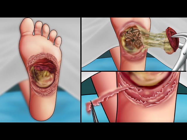ASMR Remove maggot from hole diabetic foot ulcer | Treatment animation