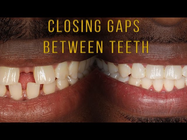 Closing Gaps Between Teeth With Braces