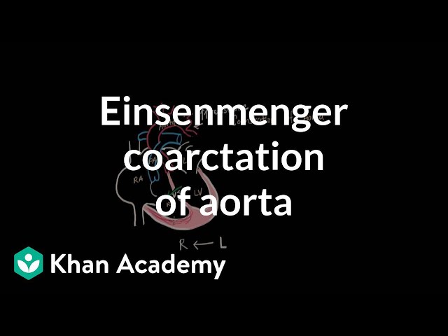 Einsenmenger coarctation of aorta | Circulatory System and Disease | NCLEX-RN | Khan Academy