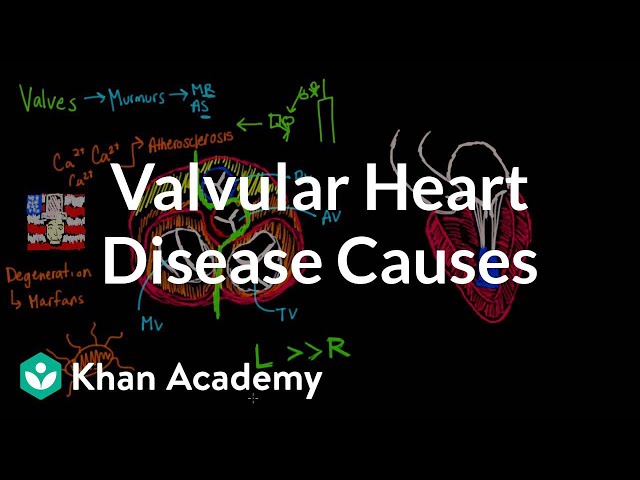 Valvular heart disease causes | Circulatory System and Disease | NCLEX-RN | Khan Academy