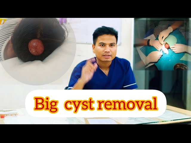 Cyst removal