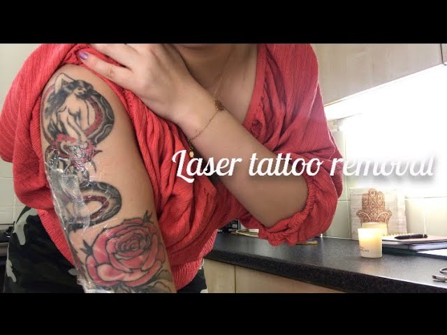 Laser Tattoo Removal - My Journey! Session 1😅