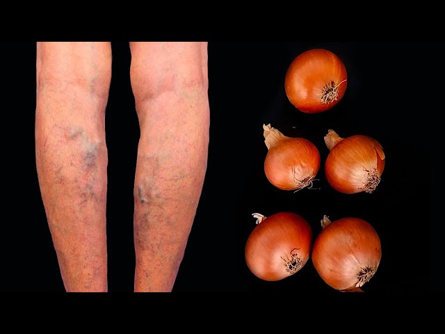 Unbelievable! Get rid of varicose veins forever! This treasure should be in every home