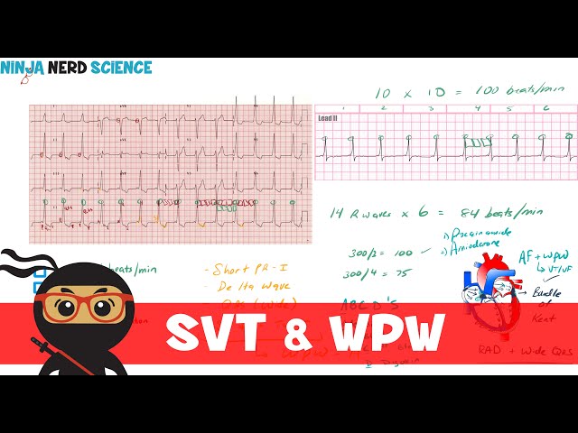 Rate and Rhythm | Supraventricular Tachycardia (SVT) and Wolff-Parkinson-White (WPW) Syndrome