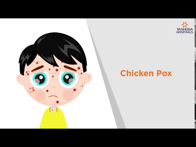 Chicken Pox: Symptoms, Causes, Prevention and Treatment | Yashoda Hospitals