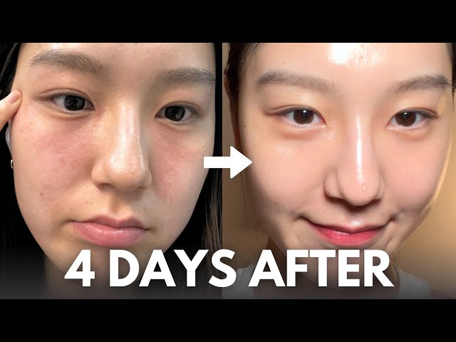 How I repair my skin barrier in 4 days (at home, with affordable skincare routine)