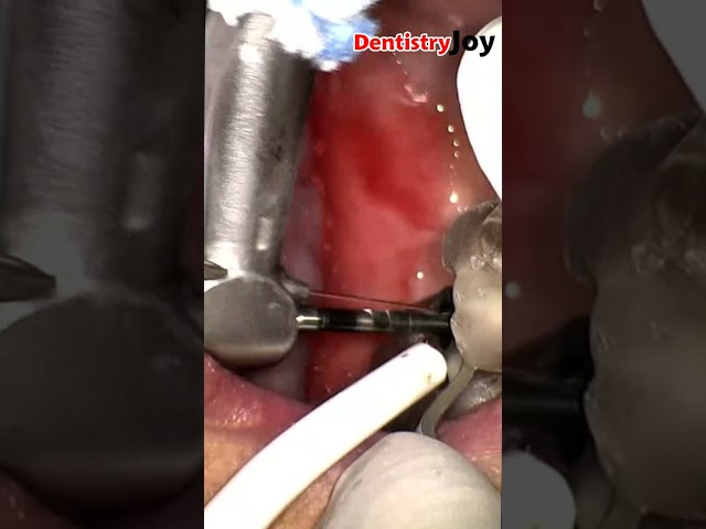 سینوس لیفت با تکنیک کلوز و استفاده از کیت اسئودنسیفیکیشن  و انجام ایمپلنت دندان بصورت همزمان